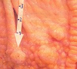 Nódulos en la mucosa estomacal causados por Hyostrongylus  rubidus. © J. Kaufmann / Birkhäuser Verlag