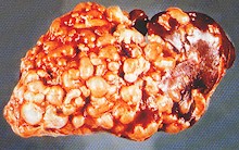 Hígado de ovino con quistes de Echinococcus granulosus. © J. Kaufmann / Birkhäuser Verlag