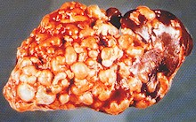 Sheep liver with numerous hydatid cysts. © J. Kaufmann / Birkhäuser Verlag