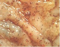 Nodules in the mucosa of the large intestine caused by encysted larvae. Image from www.askjpc.org