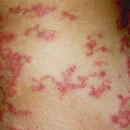 Human cutaneous larva migrans. Picture from Wikipedia Commons.