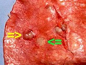 Protostrongylus nodules in an affected lung. Picture from wa.wikipedia.org/wik